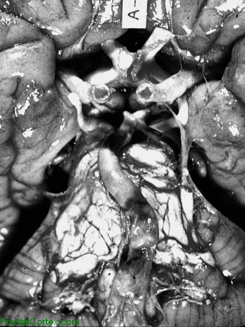 Basilar artery thrombosis, ventral surface of brain.
